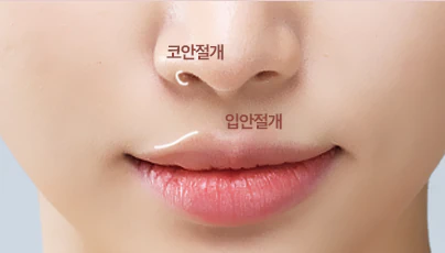 귀족수술 시 고려사항 (절개방법)